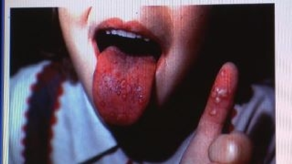 New Cases Of Hand Foot Mouth Disease Spreading WBMA