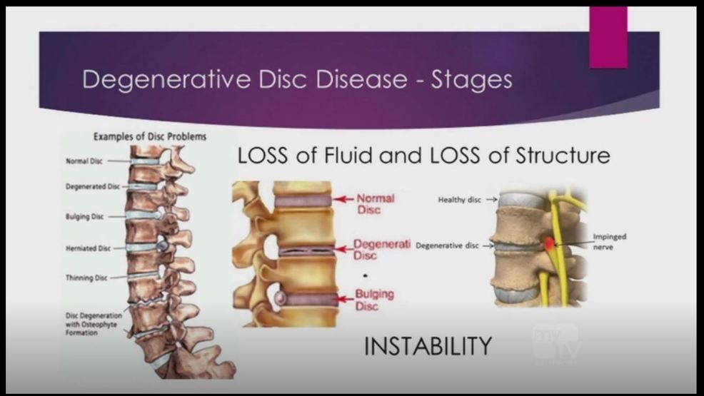 GBMC HEALTH: Degenerative Disk Disease