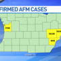 Michigan confirms two more children with acute flaccid myelitis