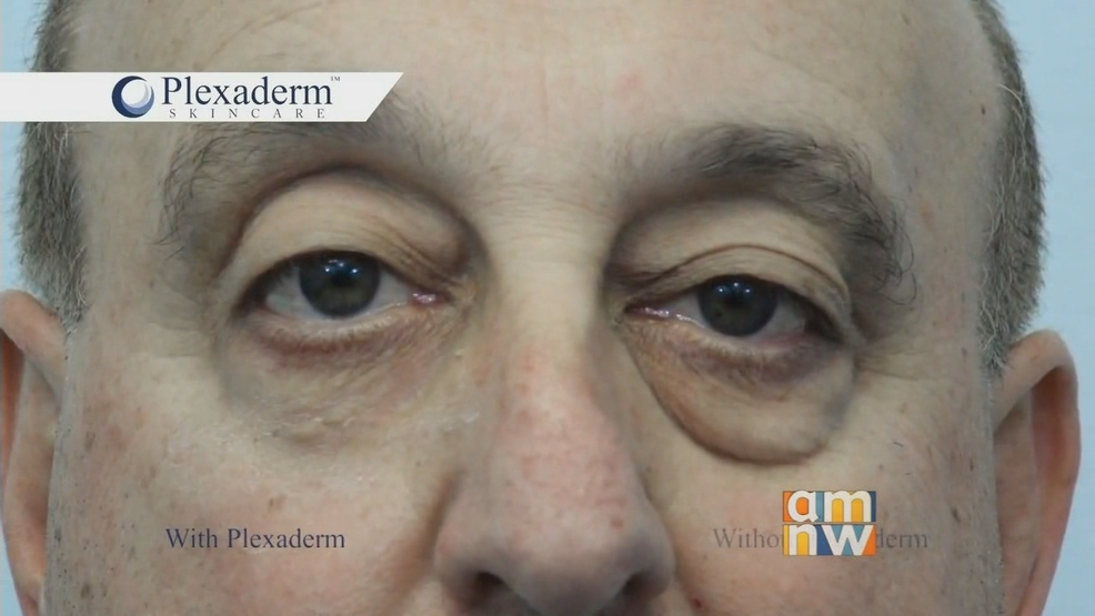 plexaderm eye